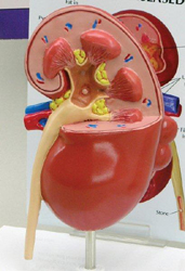 Kidney Diseased Model ( Back Side) Pharmaceutical and Anatomical Model Gifts